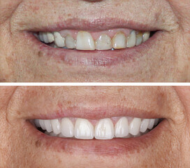 In dental aesthetic dentistry, smile design treatment with laminate veneers and zirconium crowns. Smile makeover dental before and after. © UniqDream