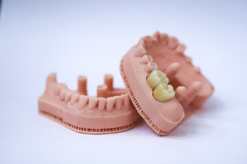 Porcelain bridge crown treatment designed with digital dentistry and produced on a jaw model using a 3D printer. dental smile makeover. laminate veneers
