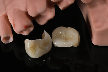 Dental porcelain crowns. Dental laminate veneers in smile design treatment in dentistry. Smile makeover.  © UniqDream