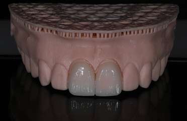 Computer-aided smile design treatment with porcelain crowns in digital dental dentistry. Digital jaw model with laminate veneers for dental smile design. Smile makeover.  © UniqDream