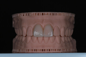 Computer-aided smile design treatment with porcelain crowns in digital dental dentistry. Digital jaw model with laminate veneers for dental smile design. Smile makeover.  © UniqDream
