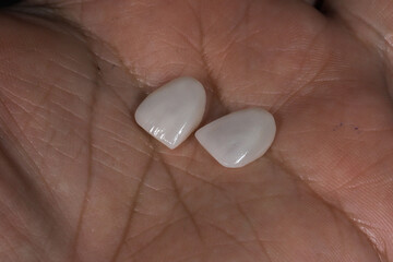 Dental porcelain crowns. Dental laminate veneers in smile design treatment in dentistry. Smile makeover.  © UniqDream