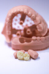 Porcelain bridge crown treatment designed with digital dentistry and produced on a jaw model using a 3D printer. dental smile makeover. laminate veneers  © UniqDream