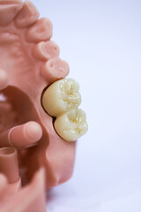 Porcelain bridge crown treatment designed with digital dentistry and produced on a jaw model using a 3D printer. dental smile makeover. laminate veneers  © UniqDream