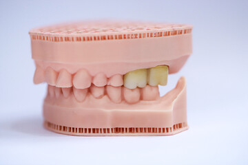Porcelain bridge crown treatment designed with digital dentistry and produced on a jaw model using a 3D printer. dental smile makeover. laminate veneers  © UniqDream