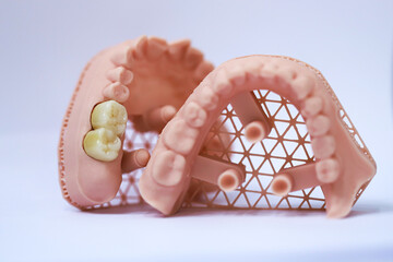 Porcelain bridge crown treatment designed with digital dentistry and produced on a jaw model using a 3D printer. dental smile makeover. laminate veneers  © UniqDream