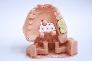 Porcelain bridge crown treatment designed with digital dentistry and produced on a jaw model using a 3D printer. dental smile makeover. laminate veneers  © UniqDream