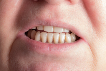 Prosthetics and orthodontic treatment. A woman demonstrates removable dentures.