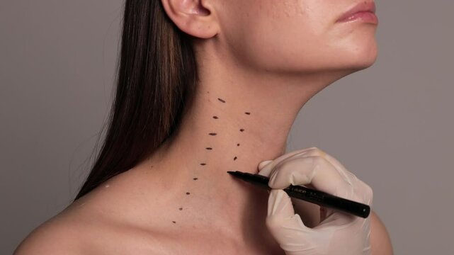 Nefertiti lifting mark up 4k video. Cosmetologist is drawing dotes before botulinum toxin injection in platysma of a woman. Improving neck by a professional. Female aesthetic cosmetology.