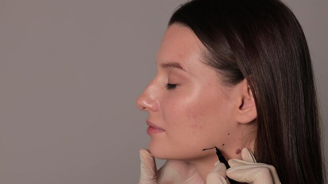 Correction of the jaw with fillers 4k video. Contouring of the corners of the jaw. Professional beauty treatment. Correcting shape of the cheekbones.
