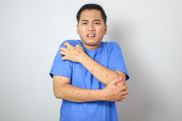 Human Hands with Painful Rash, Red Spots Blisters on the Skin. Health Problem. Monkeypox Disease...