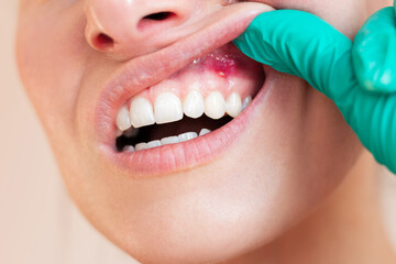 A close-up of a doctor in green gloves examining the gums of a young woman suffering from an acute...