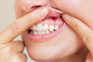 A young woman suffering from stomatitis showing her gums with an inflamed ulcer on the mucous...