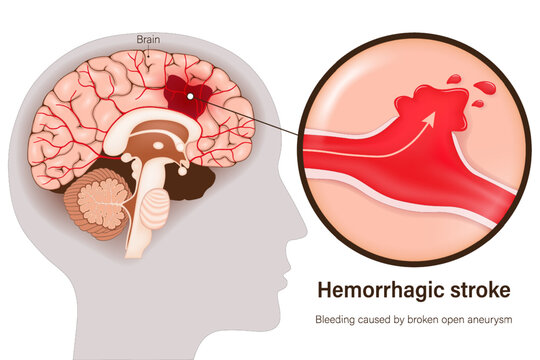 Hemorrhagic stroke vector. Bleeding caused by broken open aneurysm. Cerebral hemorrhage. Human brain anatomy structure.