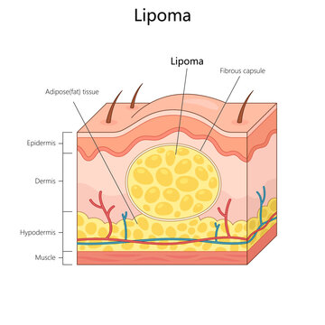 lipoma with labeled skin layers, including epidermis, dermis, hypodermis, and fibrous capsule structure diagram hand drawn schematic vector illustration. Medical science educational illustration