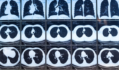 CT scans of lung diseases. MRI for diagnosis chest healthcare.
