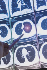 Vertical image of a Doctor learning CT scans of lung diseases. MRI for diagnosis chest healthcare.