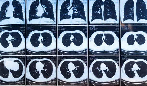 CT scans of lung diseases. MRI for diagnosis chest healthcare.