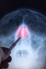 Doctor learning Vertical X-ray scan of a human skull. Deviated septum. Nasal septum, bone and cartilage that divide the nose in the middle is crooked.