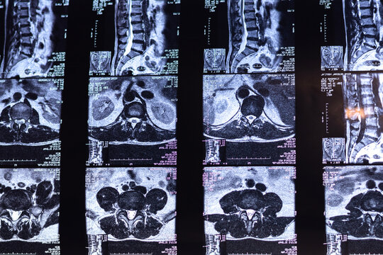 Magnetic resonance image of human spine. MRI of lumbar spine. Pinched discs of spine and nerves. Intervertebral disc herniation.