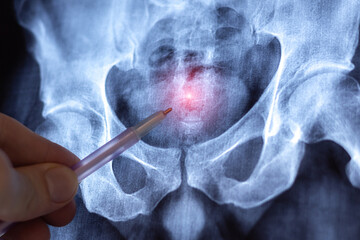 Doctor learn MRI of Bones of the Lumbar Spine and Pelvis. Pinched discs of spine and nerves....