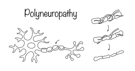 Polyneuropathy