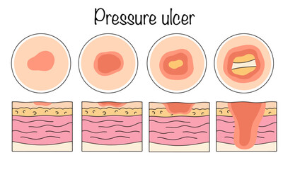 Pressure ulcer
