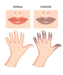Medical illustration of symptoms of cyanosis