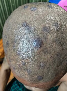 Tinea Capitis or Fungal Infection on the scalp of a patient