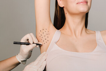 Cosmetologist is marking dotes before injecting woman's armpit, closeup. Treatment of hyperhidrosis. Markup skin for hyperhidrosis treatment in the clinic.