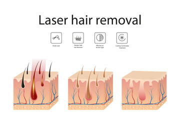 Hair follicle laser examination. Laser hair removal procedure. Step-by-step hair removal method.