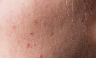 Fototapeta premium Skin problem, skin diseases. Skin acne background. Closeup acne pimple. Treatment for acne. Problem skincare. Pimples, acne, pores, scars. Skincare treatment. Pimples on skin.