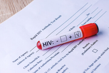 Flat Lay Of HIV Test Tube With Blood Plasma on Medical Report