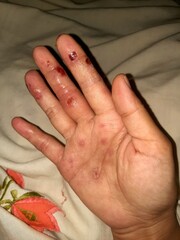 the palms of the hands are experiencing inflamed atopic dermatitis