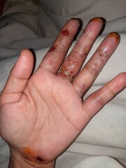 the palms of the hands are experiencing inflamed atopic dermatitis