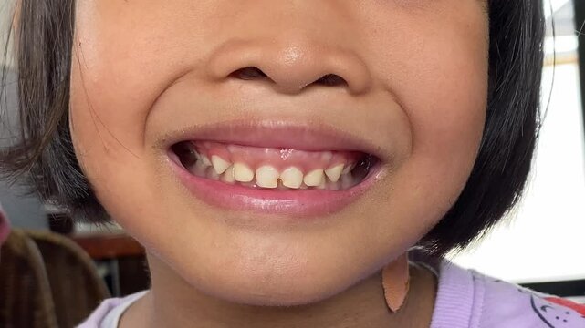 A young girl&rsquo;s baby teeth showing as she smiles, with gaps between her teeth and a slightly decayed appearance.