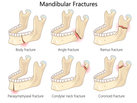 mandibular fractures, including body, angle, ramus, parasymphyseal, condylar neck, and coronoid fractures diagram hand drawn schematic vector illustration. Medical science educational illustration