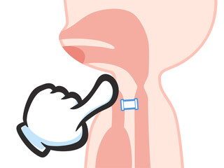 喉頭癌の手術後のシャント発声のイラスト