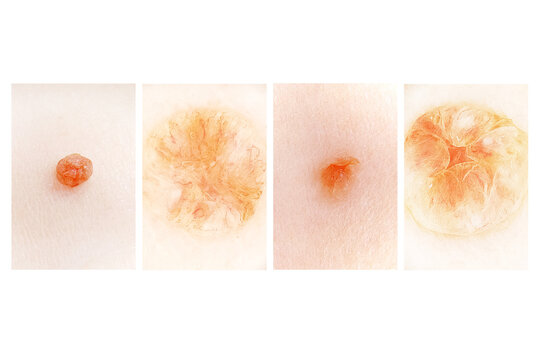 Dermal nevus of the skin. Dermatoscopic picture. Dermatological set.