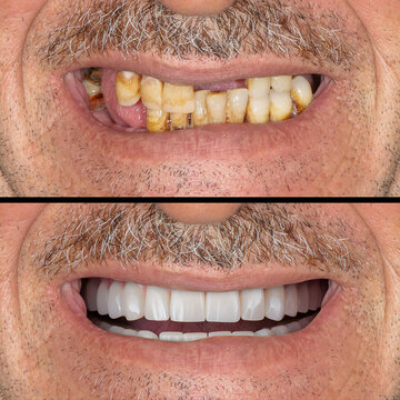 Full-arch dental prosthesis with the All on Four and All on X treatment concept for edentulous jaws in dental implant treatment. Dental X ray image and dental before and after smile design.