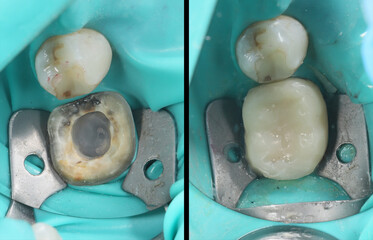 Supporting and strengthening tooth enamel with porcelain crowns in dental aesthetic dentistry.   © UniqDream