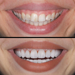 In aesthetic dentistry, E-Max and zirconium porcelain crowns are used to align teeth and treat discolored teeth. Dental before and after smile makeover. Tooth and teeth treatment smile design  © UniqDream