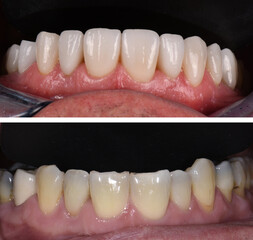 In aesthetic dentistry, E-Max and zirconium porcelain crowns are used to align teeth and treat discolored teeth. Dental before and after smile makeover. Tooth and teeth treatment smile design  © UniqDream
