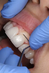 Restoring aesthetics and chewing function with glass-ceramic porcelain dental crowns in dental aesthetic dentistry.


