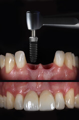 In dental implant treatment, the restoration of anterior teeth in the aesthetic zone is done using E-max or zirconium porcelains on implants. The process includes dental before and after images.
