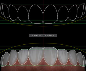 In aesthetic dentistry, digital smile design involves creating an enhanced smile using laminate veneers and zirconium materials. dental before after smile makeover. © UniqDream