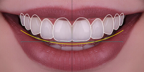 Smile design treatment and smile makeover with porcelain laminates to restore teeth and dental...