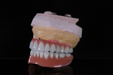 Full-arch porcelain implant-supported dental prosthesis for edentulous jaws with All-on-X and All-on-4 treatment procedure using dental implant surgery.