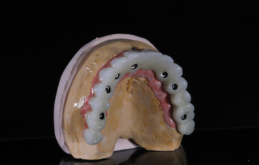 Full-arch porcelain implant-supported dental prosthesis for edentulous jaws with All-on-X and All-on-4 treatment procedure using dental implant surgery.