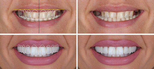 PrintSmile design treatment in dental aesthetic dentistry with laminate veneers and dental crown...